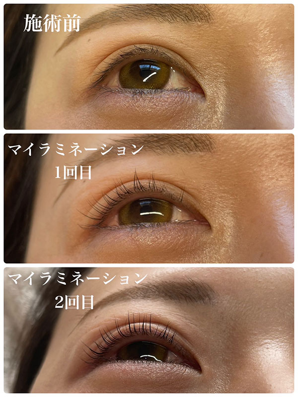 マイラミネーション ビフォーアフター